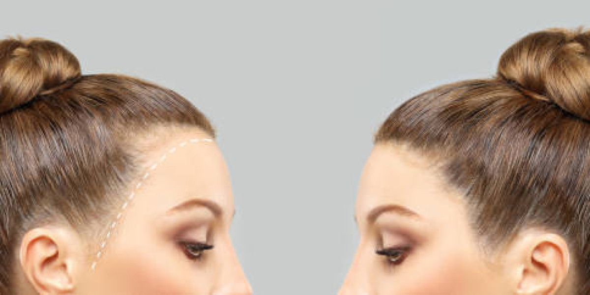 Tips for Selecting the Best Hair Restoration Specialist in Riyadh