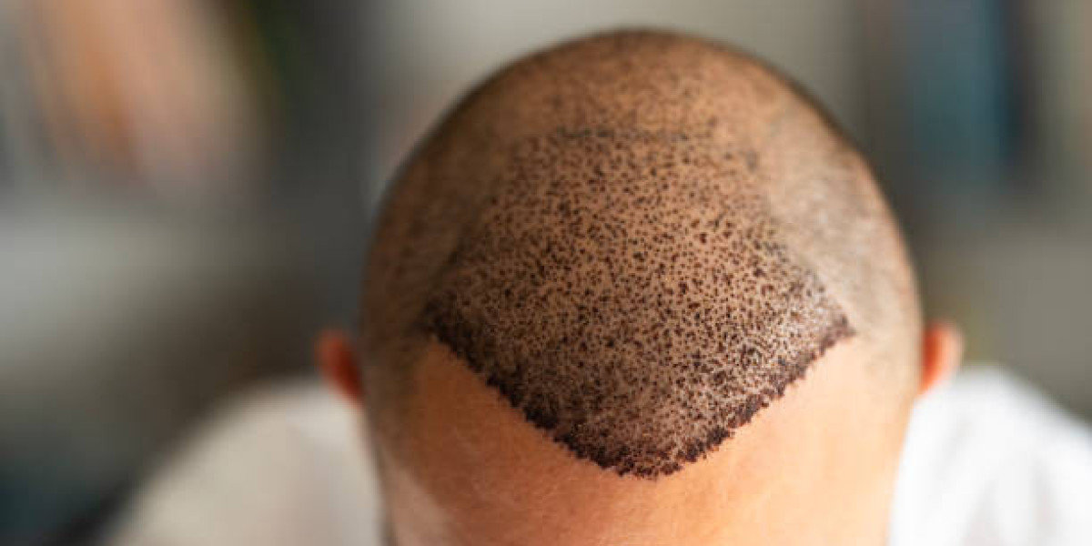 Understanding the Different Types of Hair Transplants in Riyadh