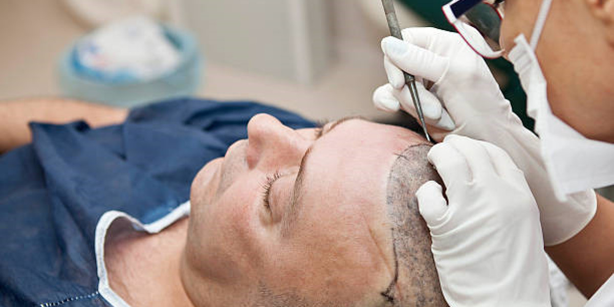 Hair Transplant in Riyadh for a Natural Looking Hairline Transformation