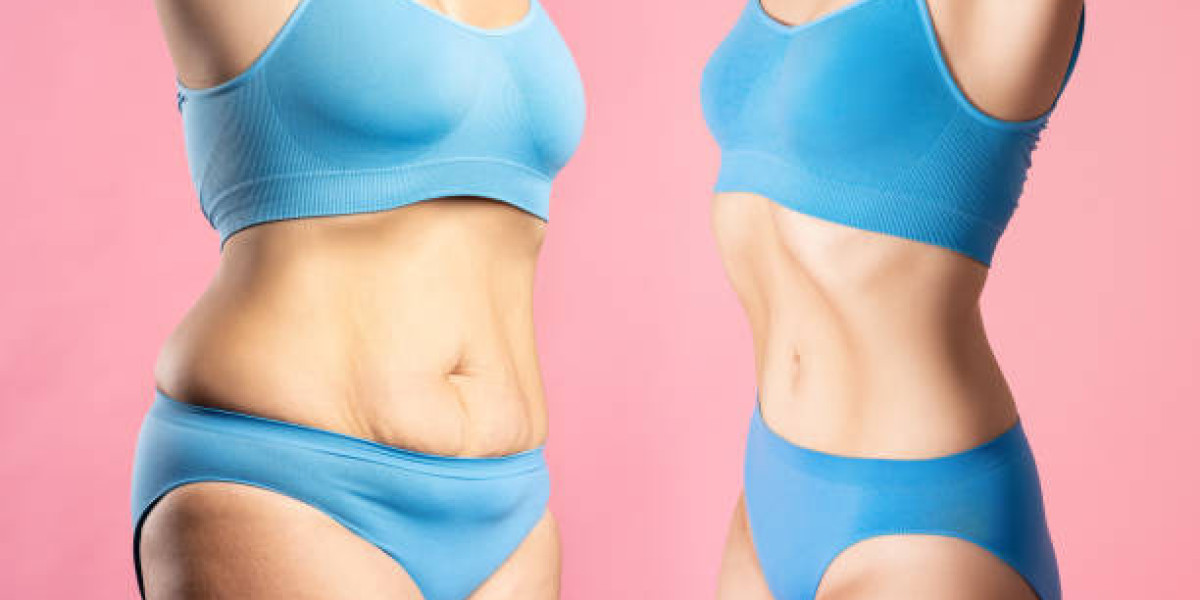 Liposuction in Riyadh and the Path to Improved Self-Confidence